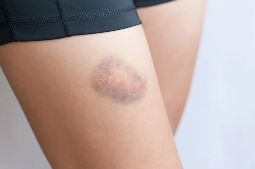 
How To Cover A Bruise
