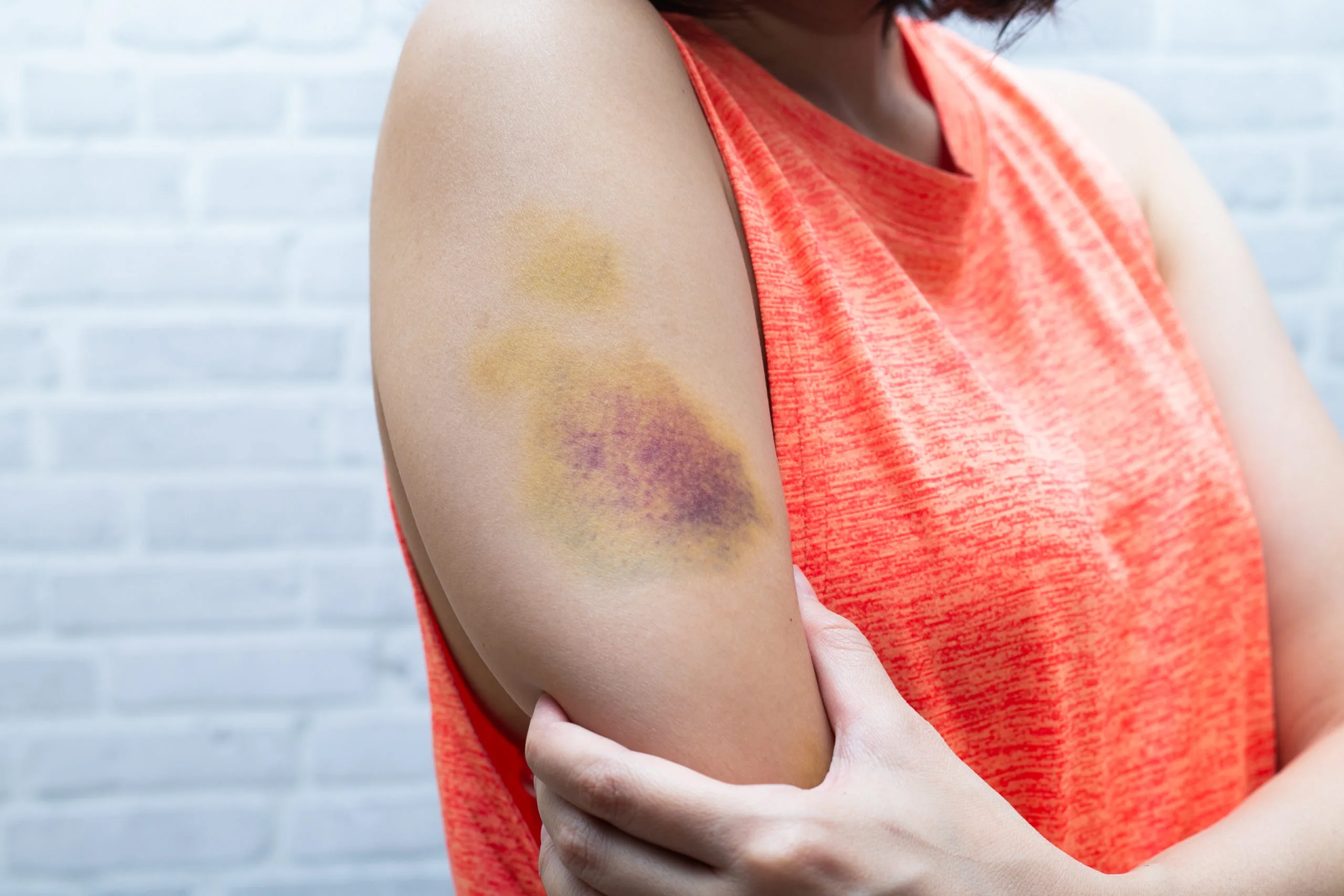 How To Cover A Bruise