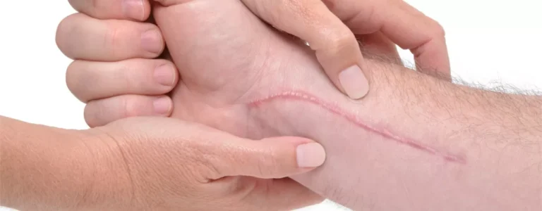 How To Get Rid Of Internal Scar Tissue How To Get Rid Of Internal Scar Tissue